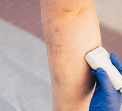 Vein Removal
