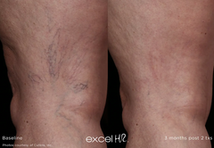 Vein Removal