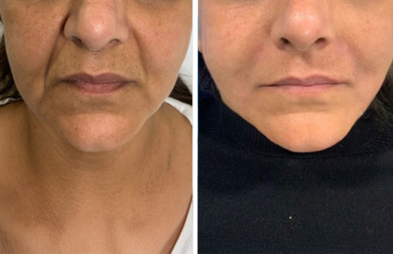 Dermal Fillers