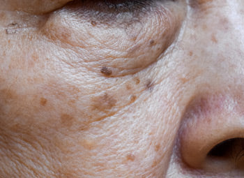 AGE SPOTS