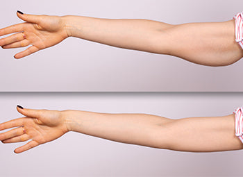 ARMS – BINGO WINGS, FAT LOSS, SKIN TIGHTENING & STRETCH MARKS