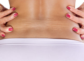 BACK – FAT LOSS, SKIN TIGHTENING & STRETCH MARKS