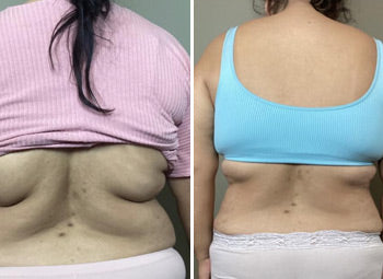 BRA FAT – FAT LOSS