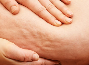 LEGS – CELLULITE, FAT LOSS & STRETCH MARKS