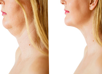 NECK – SAGGING, LINES & TURKEY NECK