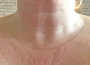 DECOLLETAGE – SKIN TIGHTENING & REDNESS