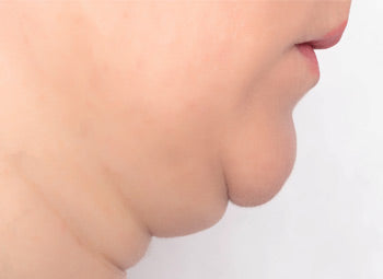 CHIN – DOUBLE CHIN, FAT LOSS & SKIN TIGHTENING
