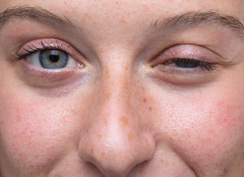 EYELIDS – DROOPING