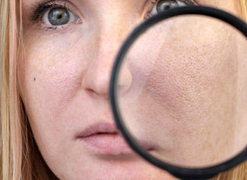 ENLARGED PORES