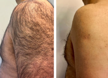 HAIR – REMOVAL & THINNING