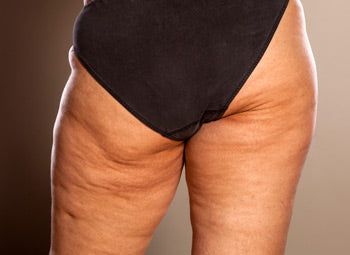 CELLULITE