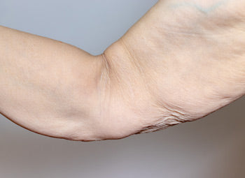 LOOSE SKIN