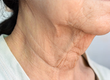 NECK – LINES & AGEING