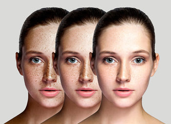 PIGMENTATION