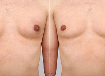 CHEST – MALE FAT LOSS