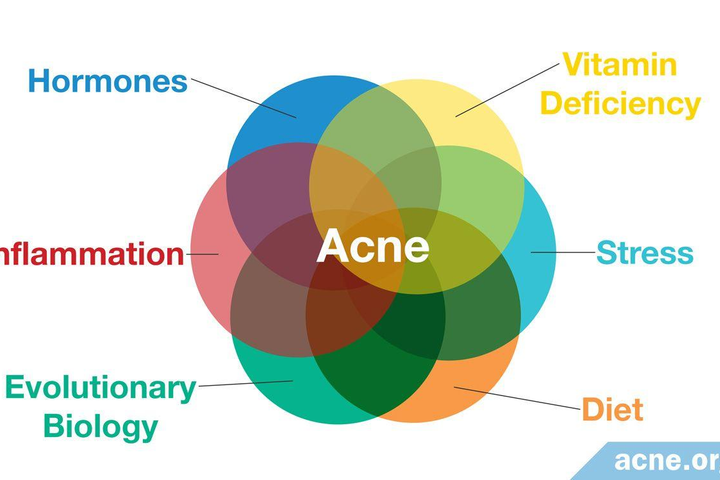 Treating Acne Properly: Why Over-the-Counter Isn't Always Enough