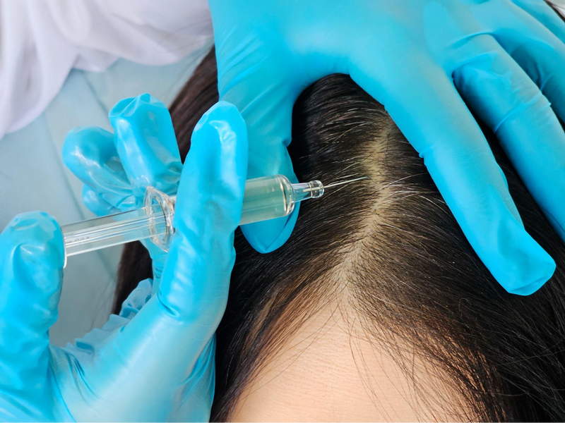 Hair Restoration Treatments: KeraLase, Keravive and Scalp Health Explained