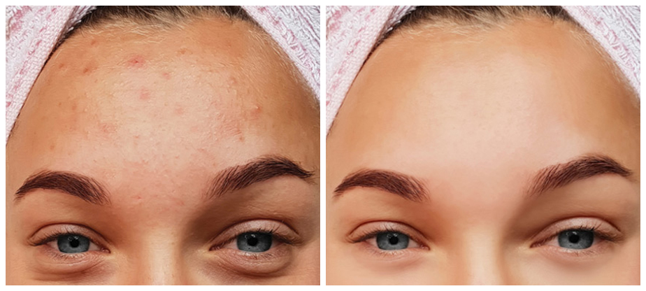 hydra-facial-before-after-01A