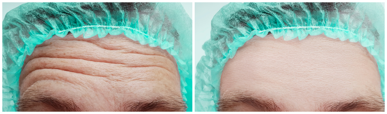 anti-wrinkle-before-and-after-01A