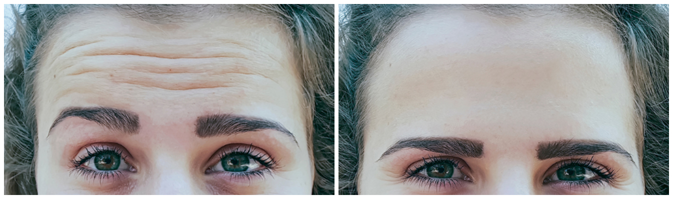 anti-wrinkle-before-and-after-02A