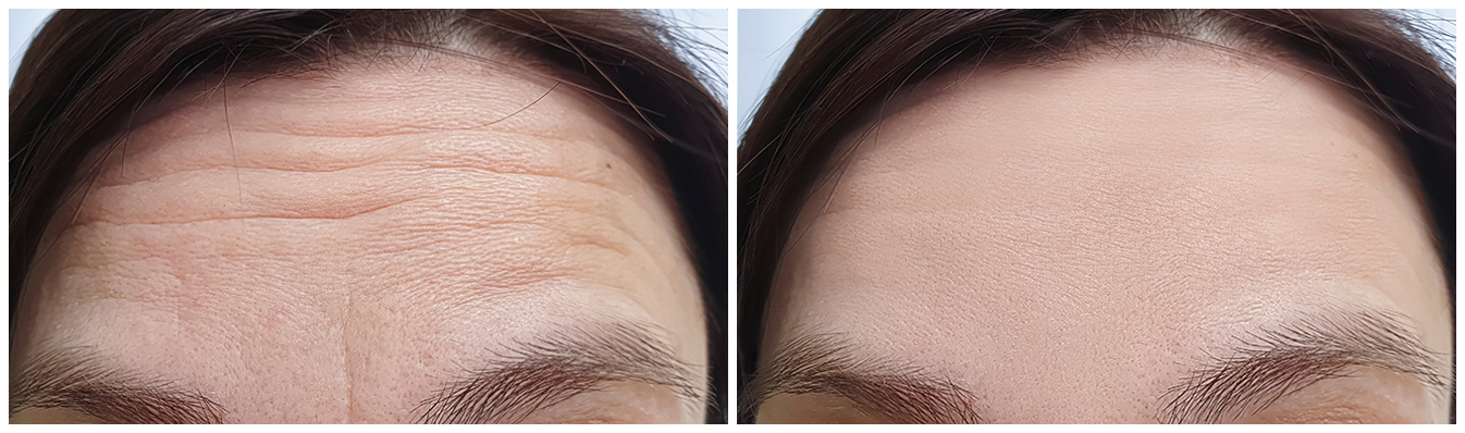 anti-wrinkle-before-and-after-03A