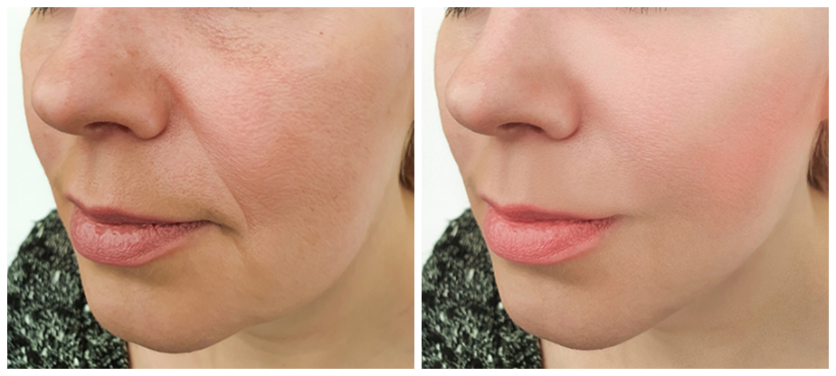 dermal-fillers-before-after-02A