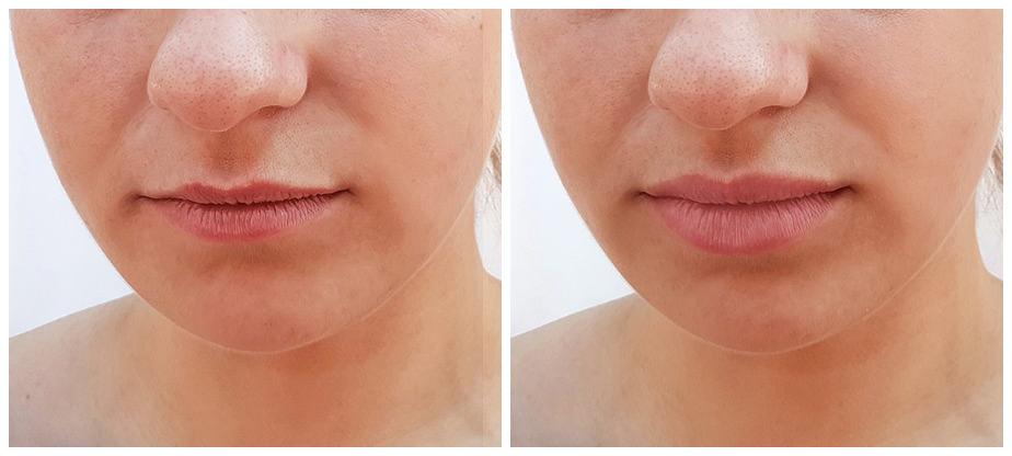 dermal-fillers-before-after-03A