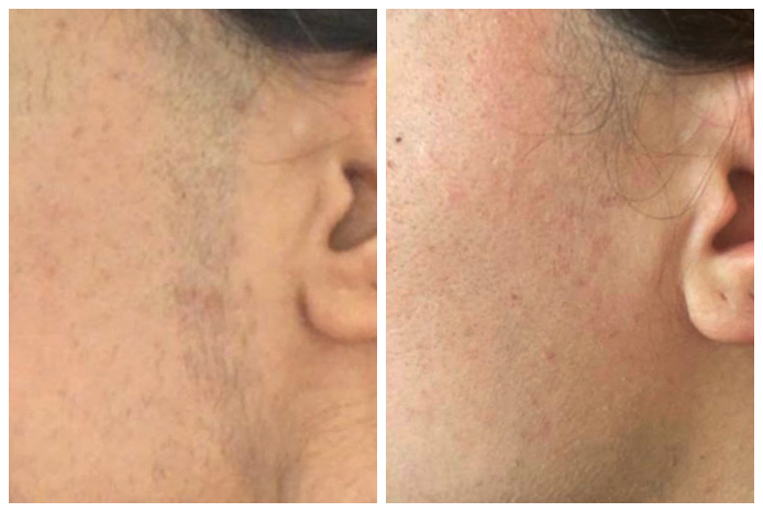 laser-hair-removal-before-after-02A