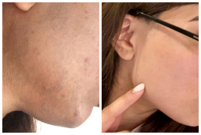 laser-hair-removal-before-after-03A