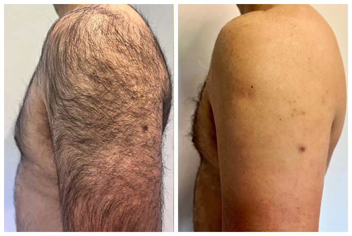 laser-hair-removal-before-after-04A