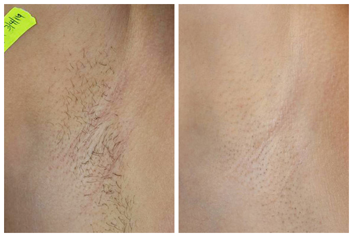 laser-hair-removal-before-after-05A