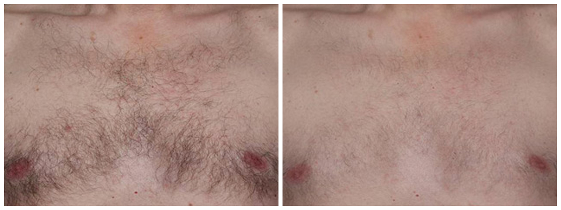 laser-hair-removal-before-after-06A