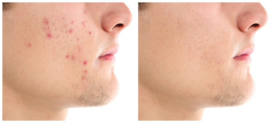 mens-cosmetic-treatments-before-after-01A