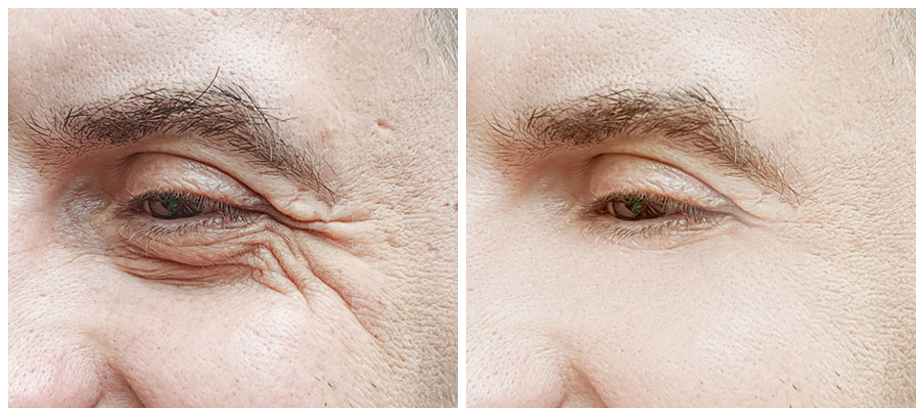 mens-cosmetic-treatments-before-after-02A