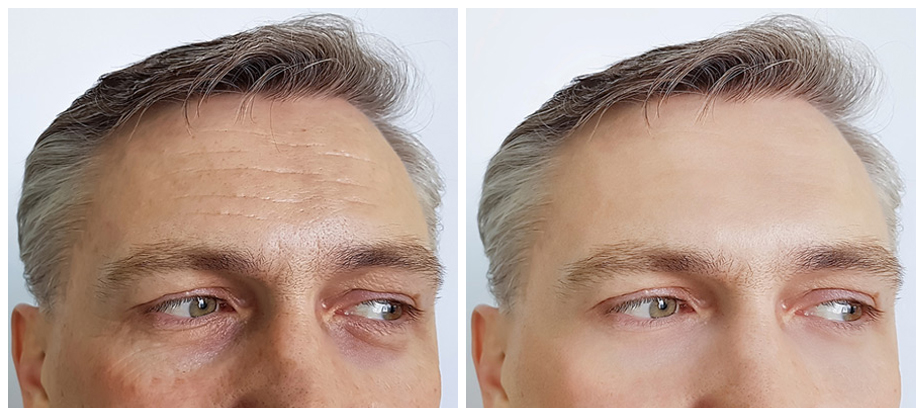 mens-cosmetic-treatments-before-after-03A