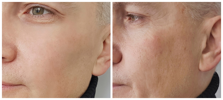 mens-cosmetic-treatments-before-after-04A