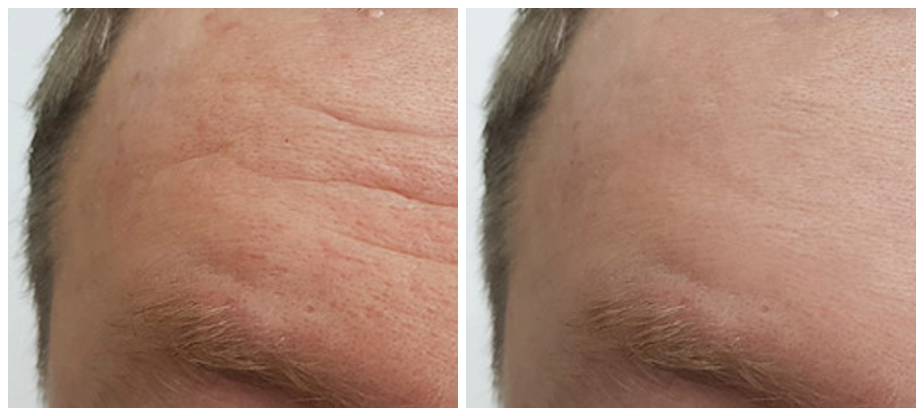 mens-cosmetic-treatments-before-after-05A