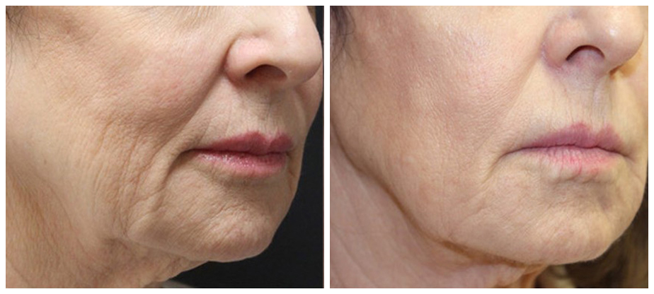 skin-tightening-before-after-01A