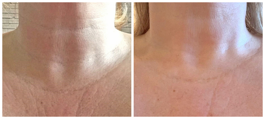 skin-tightening-before-after-02A