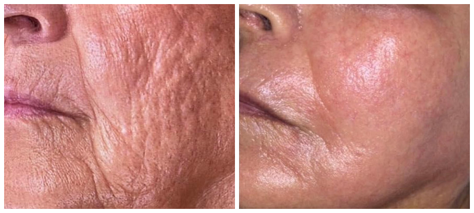 skin-tightening-before-after-04A