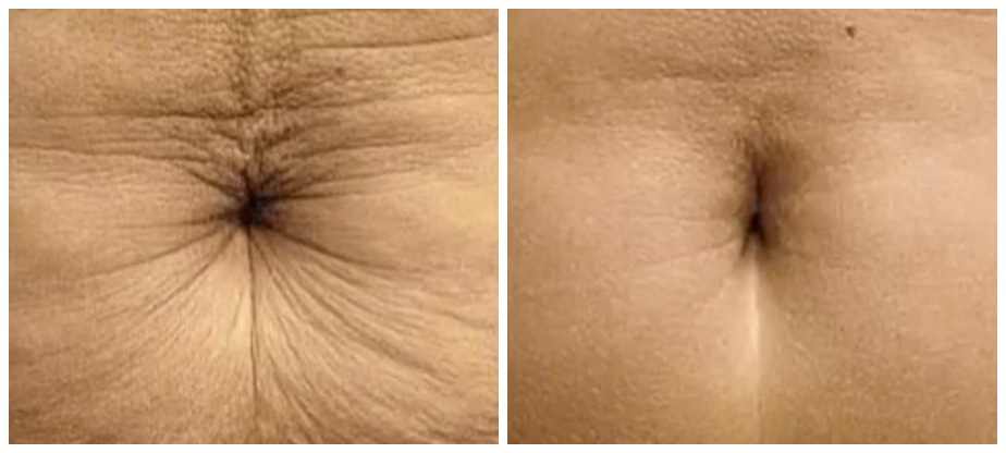 skin-tightening-before-after-05A (1)