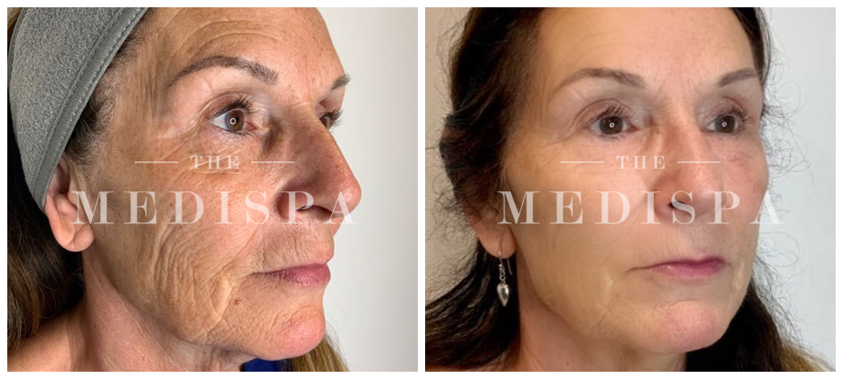 skin-tightening-before-after-05A