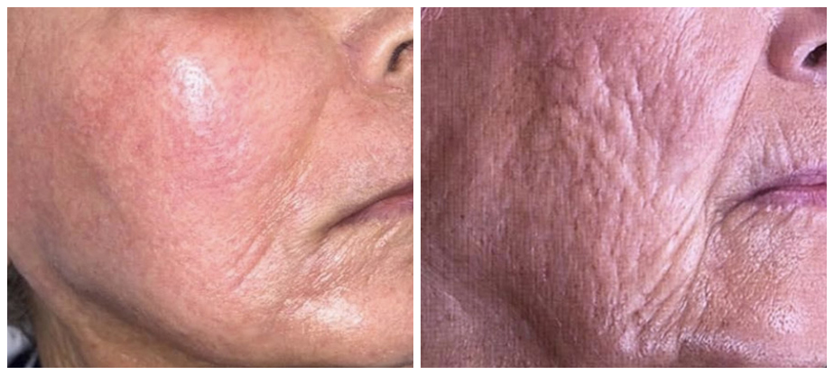 skin-tightening-before-after-06A