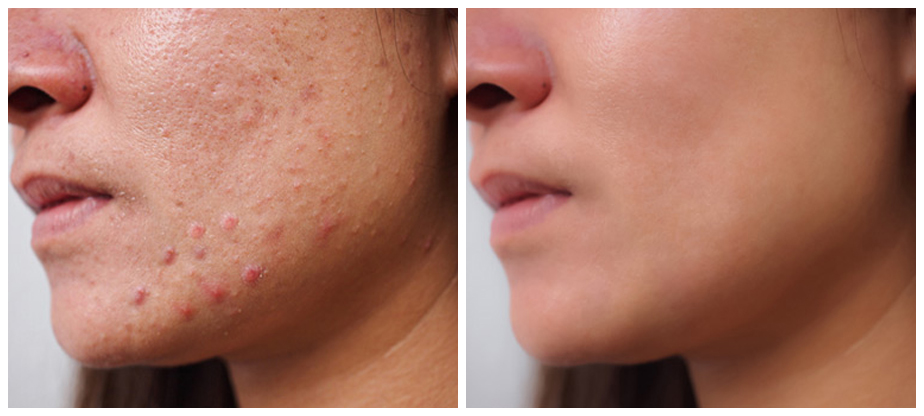 skincare-before-after-02A