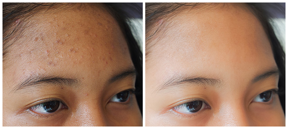 skincare-before-after-04A