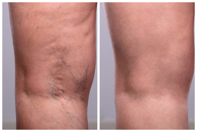 vein-pigment-before-and-after-01A