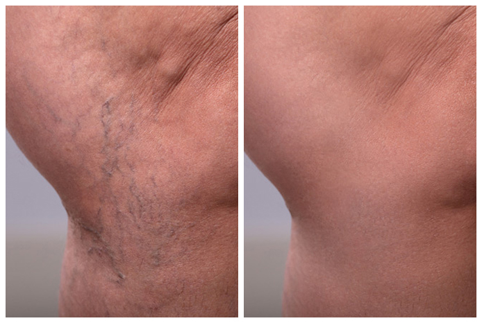 vein-pigment-before-and-after-02A