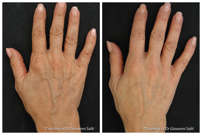 vein-pigment-before-and-after-03A